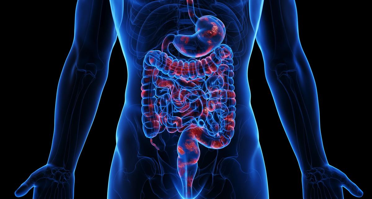 Wie toxische Darmbakterien eine Colitis ulcerosa verursachen könnten – News – Deutsches Ärzteblatt